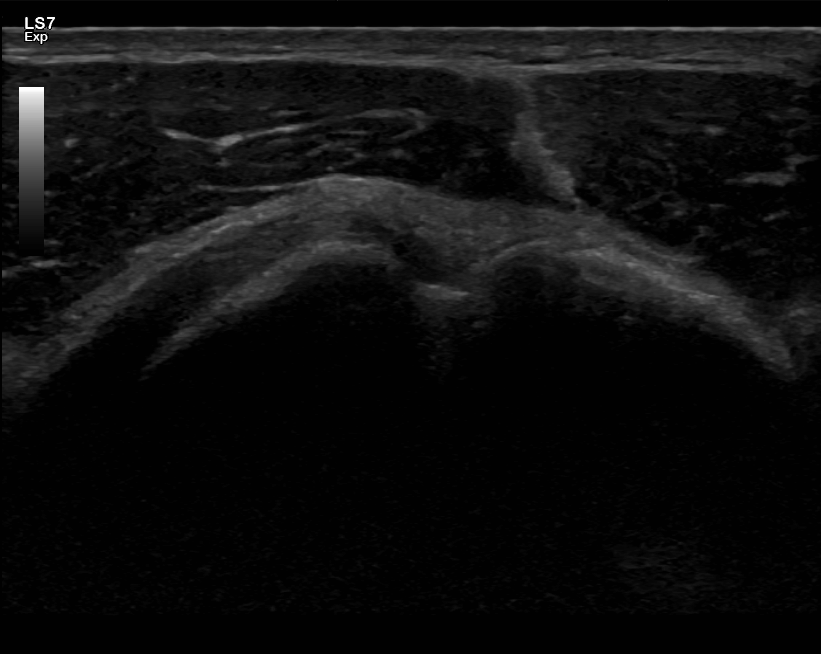 Ultraäänikuva olkapään hauisjänteestä